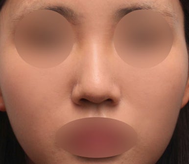 보형물 없이 하는 코수술, 무보형물 코수술이 가능한 경우는? 관련 이미지 1
