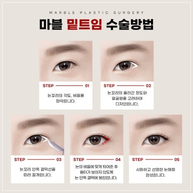 눈성형잘하는병원, 쌍꺼풀수술, 트임수술 관하여 관련 이미지 15