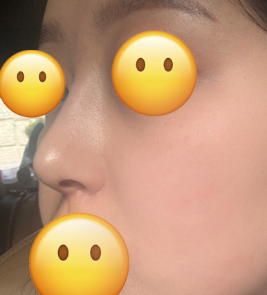 [Bulbous Nose Surgery Review] Solved My Plain Bulbous Nose Concerns! I Got a More Defined Nasal Bridge and a Better Impression! image 6