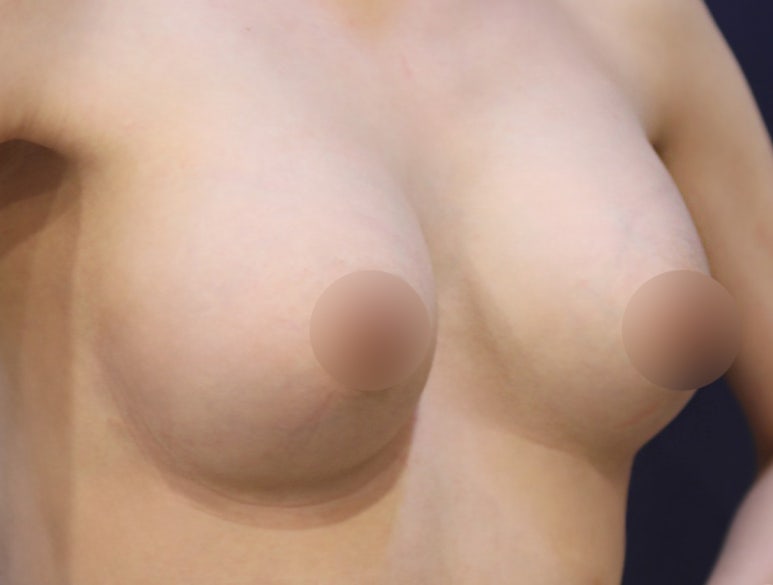 가슴수술 후 불편함, 부작용 때문일까요? 가슴재수술 전 확인 포인트 관련 이미지 3