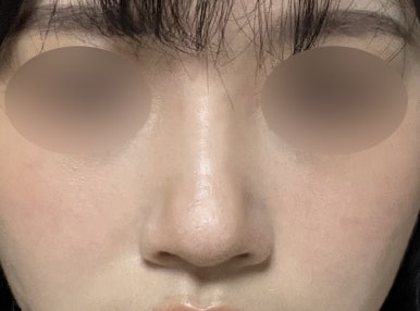 [강남성형외과 복코수술 후기] 사진 찍기 두렵던 뭉툭한 코.. 김준형원장님 만나고 세련된 라인이 됐어요! 관련 이미지 4