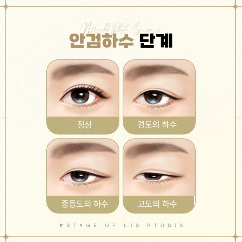 눈매교정부작용 벗어날 방법 알아보기 관련 이미지 6