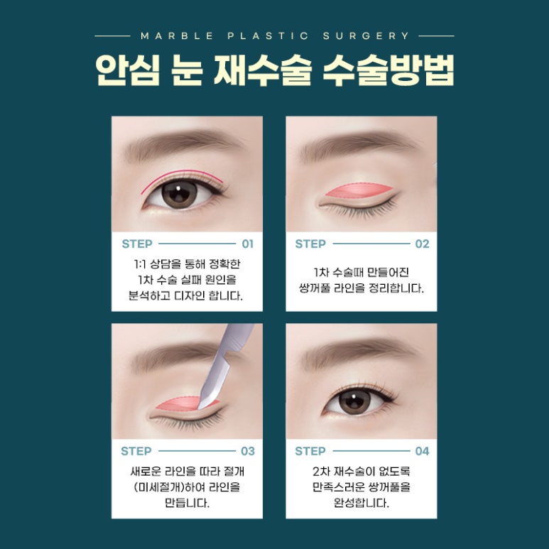쌍꺼풀재수술 새로운 시작을 위한 가이드 관련 이미지 3
