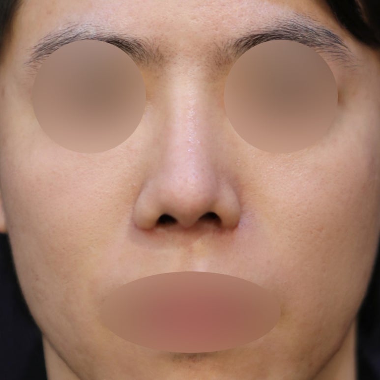Improving Your Impression Before and After Male Rhinoplasty image 4