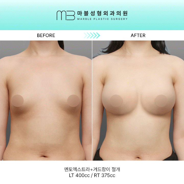 [멘토 가슴성형] 가슴수술 3개월 차: 멘토엑스트라와 맞춤 라인의 정석 관련 이미지 1