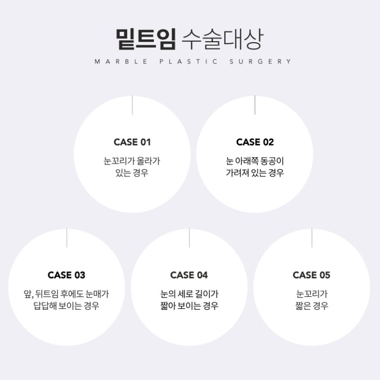밑트임전후 색다르게 눈매 변화! 마블성형외과의원 관련 이미지 3