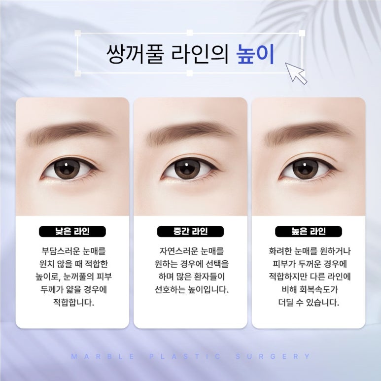 눈성형외과유명한곳, 눈 병원을 찾는다면 관련 이미지 6