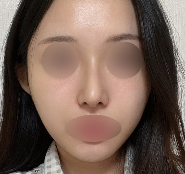 Hump Nose Surgery Is Not Simply a Procedure to Shave It Down. image 5
