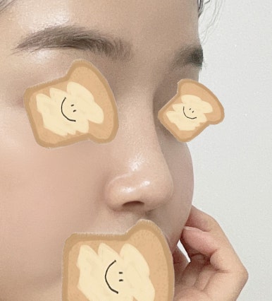 [Gangnam Station Plastic Surgery Nose Revision Review] A Tearful 4th Revision Marked by Failure... I Met Dr. Kim Jun-hyung and Succeeded! image 7
