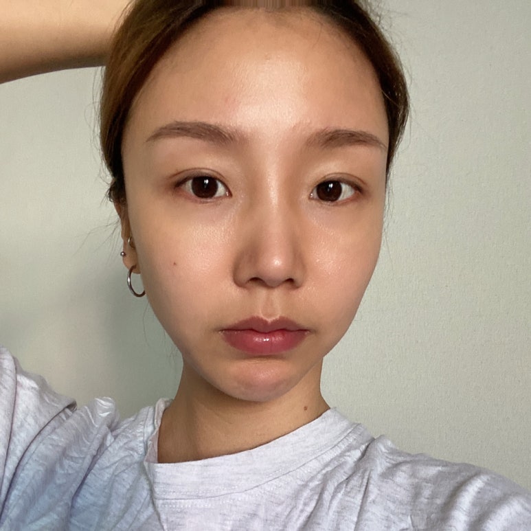 안검하수비용 어느 정도 될까? 관련 이미지 2