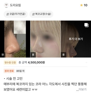 [Gangnam Plastic Surgery Hump Nose Surgery Review] The Bulky, Humped Nose That Looked Thick... A Refined Impression Achieved Without an Implant, haha image 1
