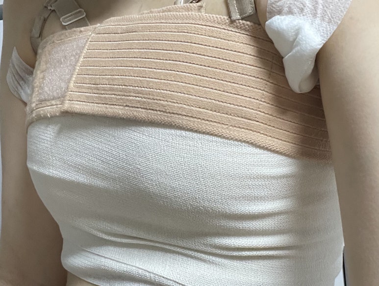 One-Month Real Review After Breast Augmentation ｜ From Right After Surgery to the Changes Over Time image 5