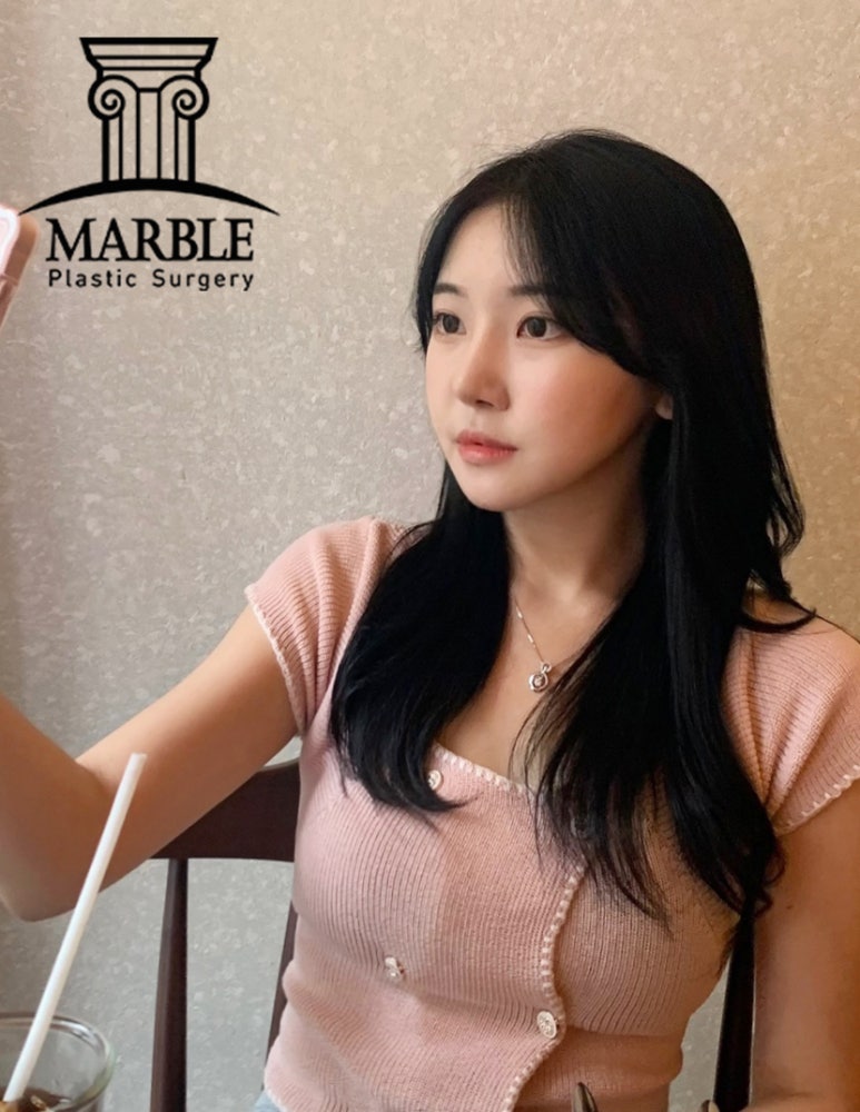 쌍꺼풀수술비용, 합리적인 변화는 마블성형외과의원! 관련 이미지 3
