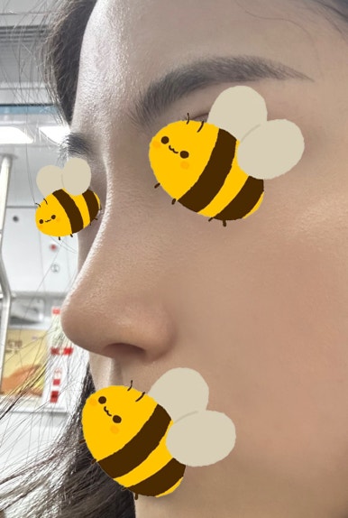[강남성형외과 매부리코성형 후기] 보기 싫었던 매부리코,, 자려한 인생 코라인 찾아 고민 해결했어요! 관련 이미지 6