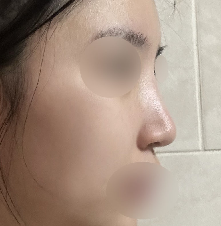 서초구 코수술 잘하는곳 마블성형외과에서 예쁜 코라인으로 변화 관련 이미지 3