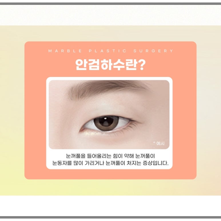 눈매교정 수술, 나도 필요한가? 관련 이미지 3