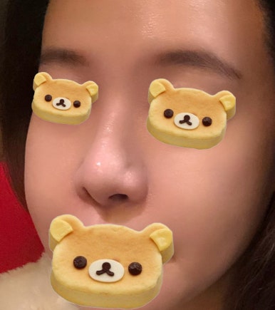 [강남역성형외과 매부리코수술 후기] 코재수술이라 진짜 무서웠는데 매부리코, 복코교정 한번에 해결 됐어요! 관련 이미지 4