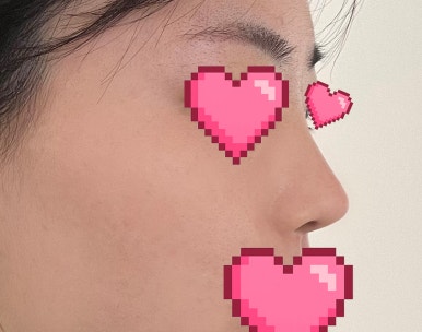 [매부리코수술 후기] 뭉툭한 코끝에 매부리가 고민이었는데..조금이라도 빨리할걸 아쉽네요ㅠㅠ 관련 이미지 8
