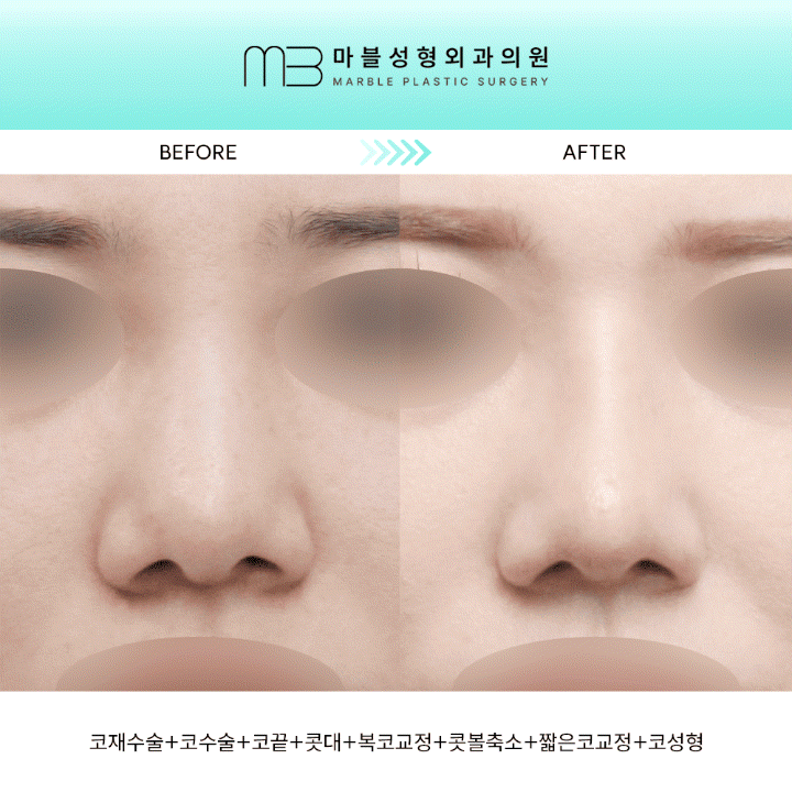 [Revision Rhinoplasty] 5 Months After Short Nose Correction: The Standard Approach to Bulbous Nose Correction and Alar Reduction image 1