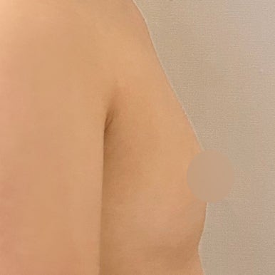 [강남역 성형외과 가슴수술 후기] 옷태 안 살던 빈약한 가슴ㅠㅠ 자연스러운 볼륨 생기고 고민 해결! 관련 이미지 5