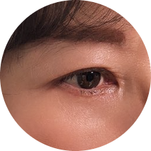 눈꺼풀지방제거 늦기 전에 지금! 관련 이미지 1