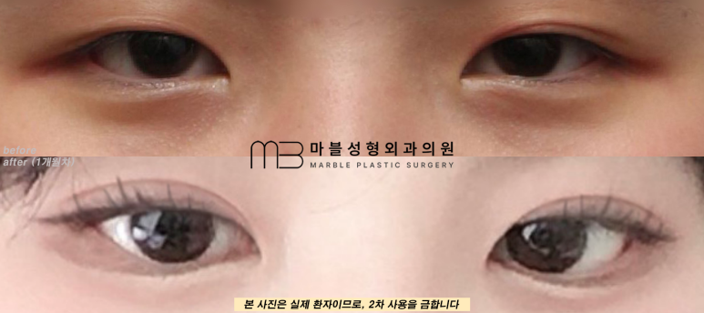 자연유착쌍꺼풀후기 눈매를 더욱 또렷하게 관련 이미지 4