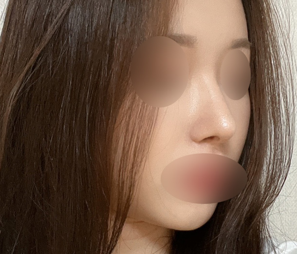 Hump Nose Surgery Is Not Simply a Procedure to Shave It Down. image 4