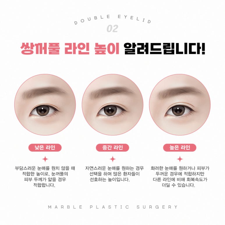 쌍꺼풀수술 고민될 때 반드시 확인해야할 것 관련 이미지 3