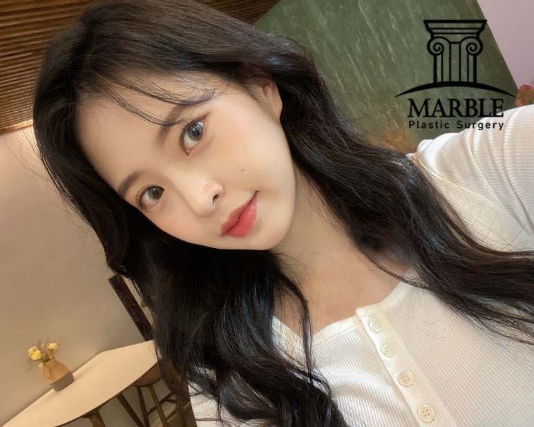 쌍꺼풀수술후기, 자연스러운 변화는 마블성형외과의원! 관련 이미지 2