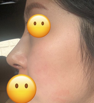 [Bulbous Nose Surgery Review] Solved My Plain Bulbous Nose Concerns! I Got a More Defined Nasal Bridge and a Better Impression! image 5