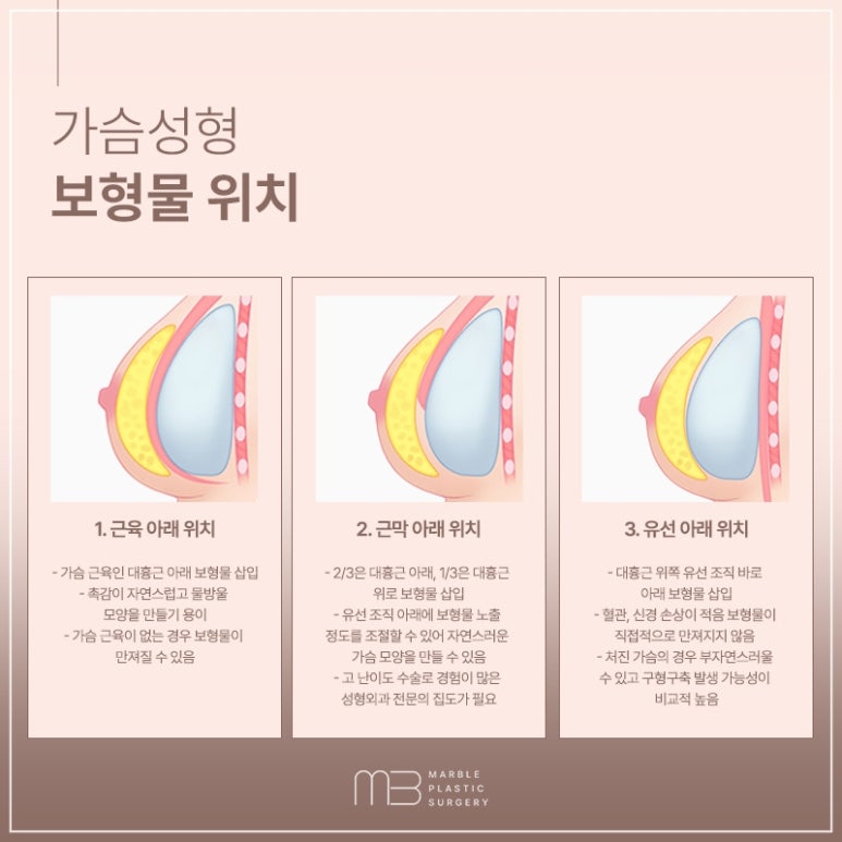 모티바가슴수술 볼륨·라인 동시에! 강남성형외과 추천 | 마블성형외과의원 관련 이미지 11