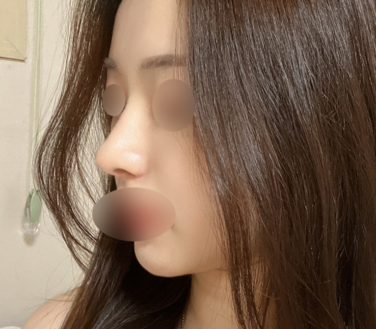 Hump Nose Surgery Is Not Simply a Procedure to Shave It Down. image 6
