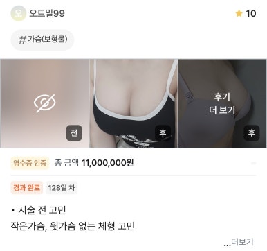 [강남역 성형외과 가슴성형 후기] 빈약한 윗가슴 콤플렉스..짝가슴도 맞춰졌고 촉감까지 완전 찐가슴이에요! 관련 이미지 1