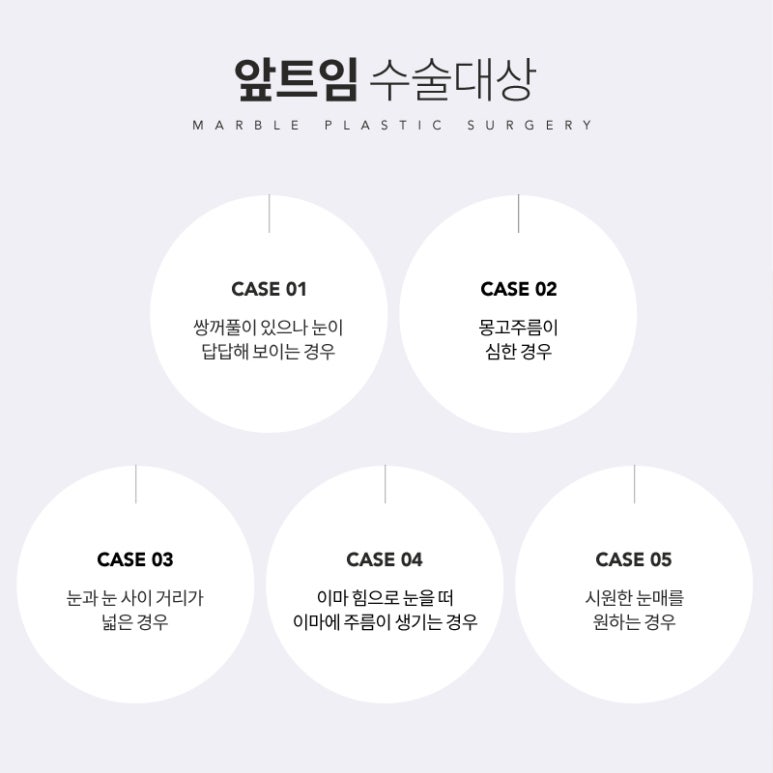 앞트임가격 시원한 눈매로 개선해 관련 이미지 3