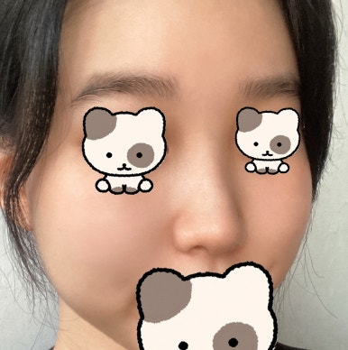 [Gangnam Station Plastic Surgery Hump Nose Surgery Review] I Escaped the Hump That Fillers Couldn’t Fix! It Looks Prettier with a Slim, Straight Line Haha image 5