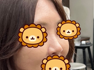 [강남성형외과 복코성형 후기] 각도 안 나오던 펑퍼짐한 코 모양.. 김준형 원장님 만나 정착했어요! 관련 이미지 5