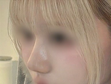 [Gangnam Plastic Surgery Hump Nose Surgery Review] The Bulky, Humped Nose That Looked Thick... A Refined Impression Achieved Without an Implant, haha image 6