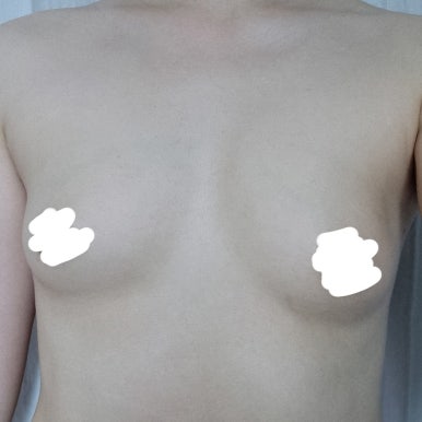 [강남역 성형외과 가슴수술 후기] 나만 알던 짝가슴 스트레스ㅠㅠ 서일범 원장님 만나고 완벽 대칭 성공ㅎㅎ 관련 이미지 4