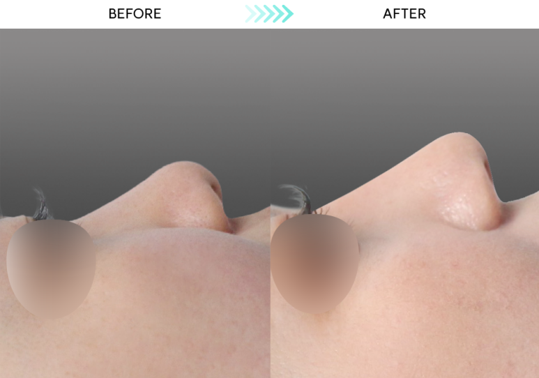 [Revision Rhinoplasty] 5 Months After Short Nose Correction: The Standard Approach to Bulbous Nose Correction and Alar Reduction image 4