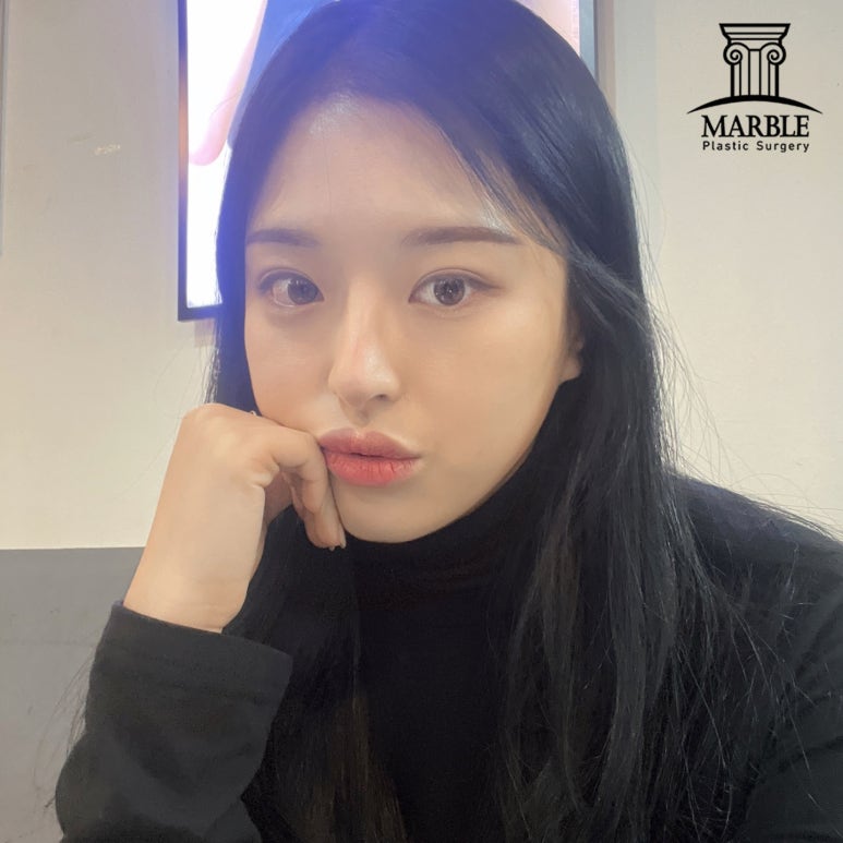 앞트임수술, 답답한 눈 탈출은 마블성형외과의원! 관련 이미지 5