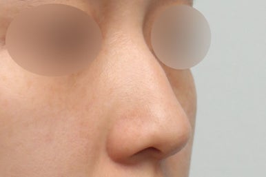 매부리코교정방법, 조화로운 코 라인의 핵심 관련 이미지 3