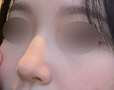 [강남성형외과 복코수술 후기] 사진 찍기 두렵던 뭉툭한 코.. 김준형원장님 만나고 세련된 라인이 됐어요! 관련 이미지 3