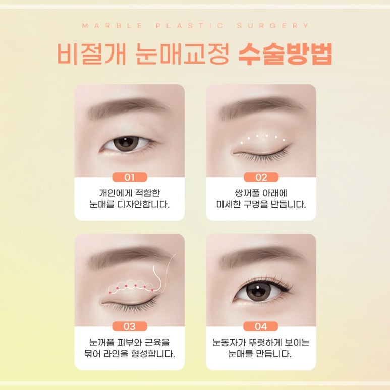 비절개눈매교정잘하는곳 장점, 선택 시 고려사항, 비용 관련 이미지 7