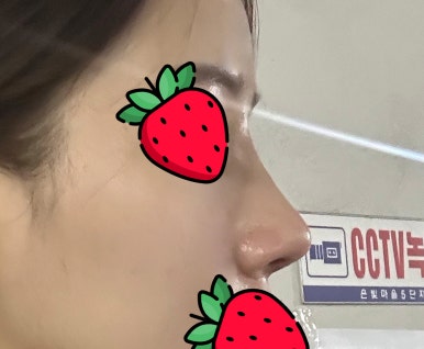 [강남성형외과 매부리코수술 후기] 인상 망치는 매부리와 복코 고민.. 직반버선 라인으로 완성했어요! 관련 이미지 8