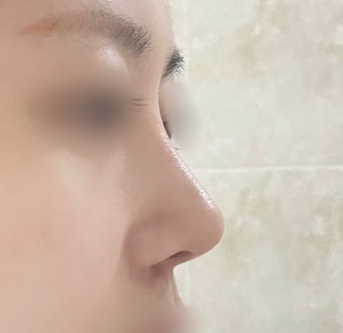 [마블성형외과 코수술 후기] 퍼진 복코에 매부리까지.. 인상 강해 보여서 거울 보기 싫었던 과거 탈출ㅠㅠ 관련 이미지 5