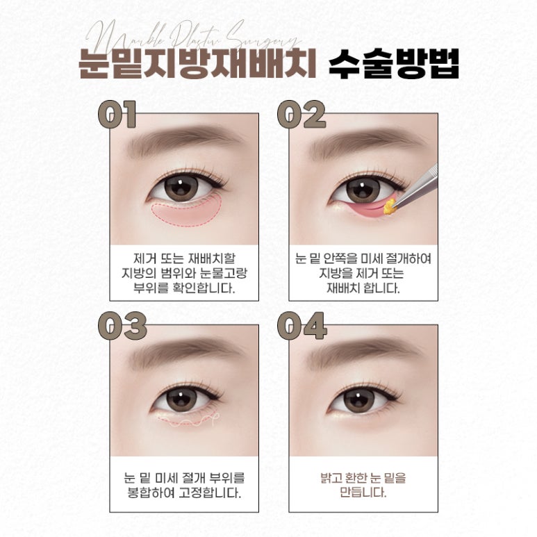 눈밑지방재배치 다크서클에 도움될 수 있을까 관련 이미지 6