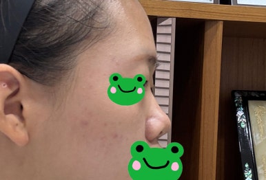 [Gangnam Plastic Surgery Rhinoplasty Review] My Short Nose Looked Upturned from the Front… Now It Has the Perfect Line with Postoperative Care Too! image 2