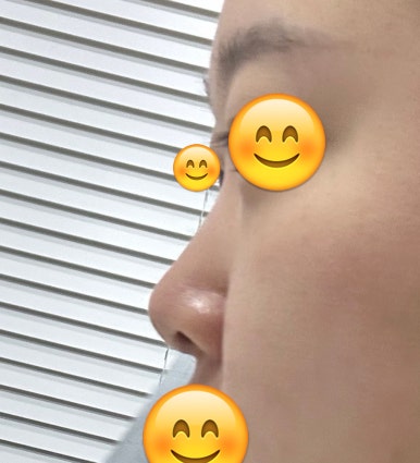 [강남역성형외과 복코성형 후기] 지인들도 부러워하는 매끄러운 코라인, 원장님 덕에 거울 볼 때마다 뿌듯해요 관련 이미지 3