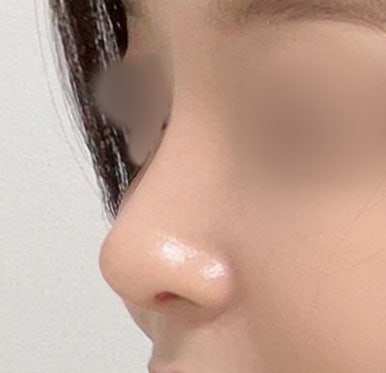 [Gangnam Plastic Surgery Clinic Rhinoplasty Revision Review] No matter how many surgeries I had, my nose still looked flat and wide... Now it has finally settled into a beautiful shape haha image 6