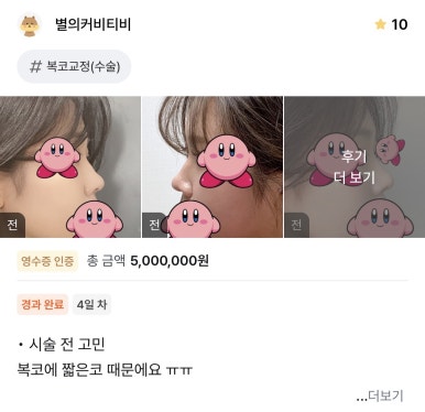 [강남역성형외과 복코수술 후기] 빡센 다이어트도 소용없던 복코.. 아이돌 코로 다시 태어났어요! 관련 이미지 1
